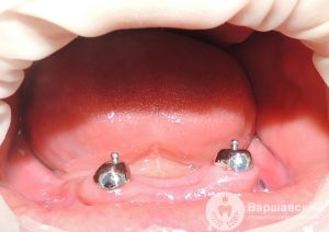протезирование зубов съемными протезами на корневых замках